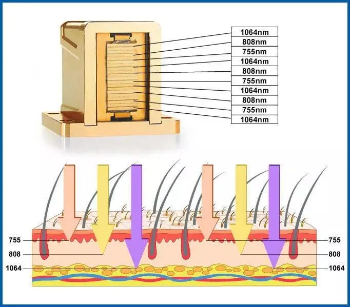 Diode Laser Painless Ice Portable Hair Removal 808nm Laser Diode Permanent Hair Removal Device 755 808 1064nm Triple Wavelength